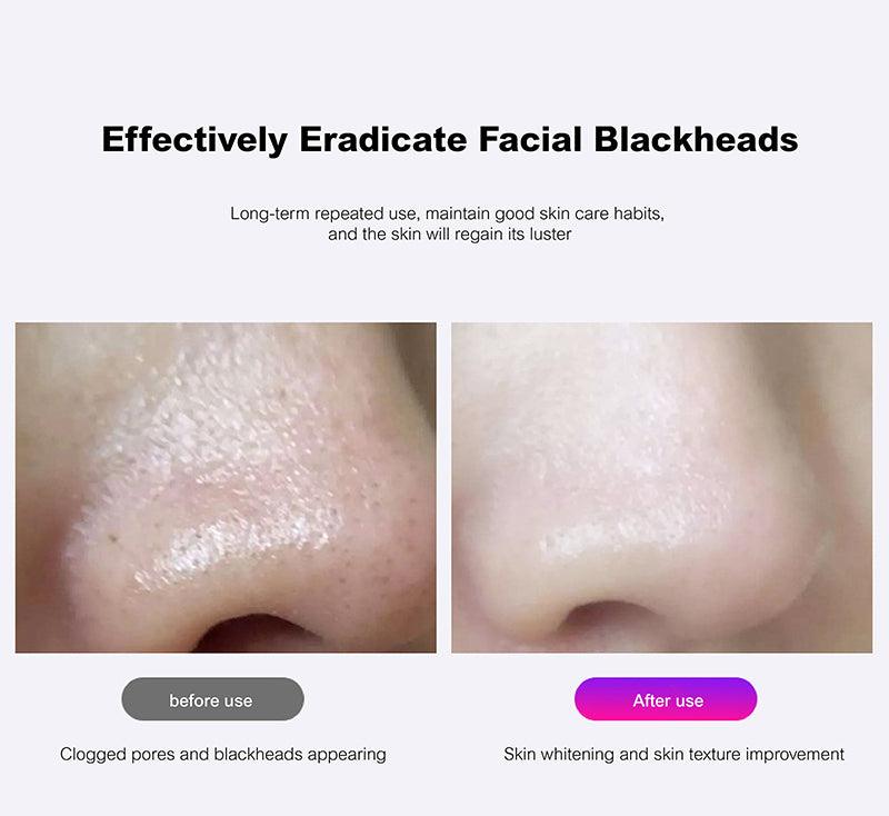Fabufabu Clean and Beauty Blackhead Acne Machine - starcopia design store
